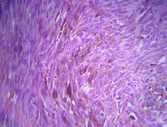 Melanoma of the Oral Cavity: About Two Cases and Review of Literature