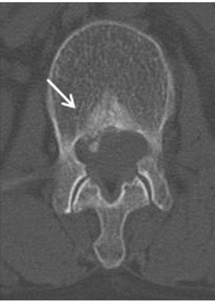 Lumbar Disc Herniation With End Plate Fracture And Secondary lumbar-disc-herniation-with-end-plate-fracture-and-secondary