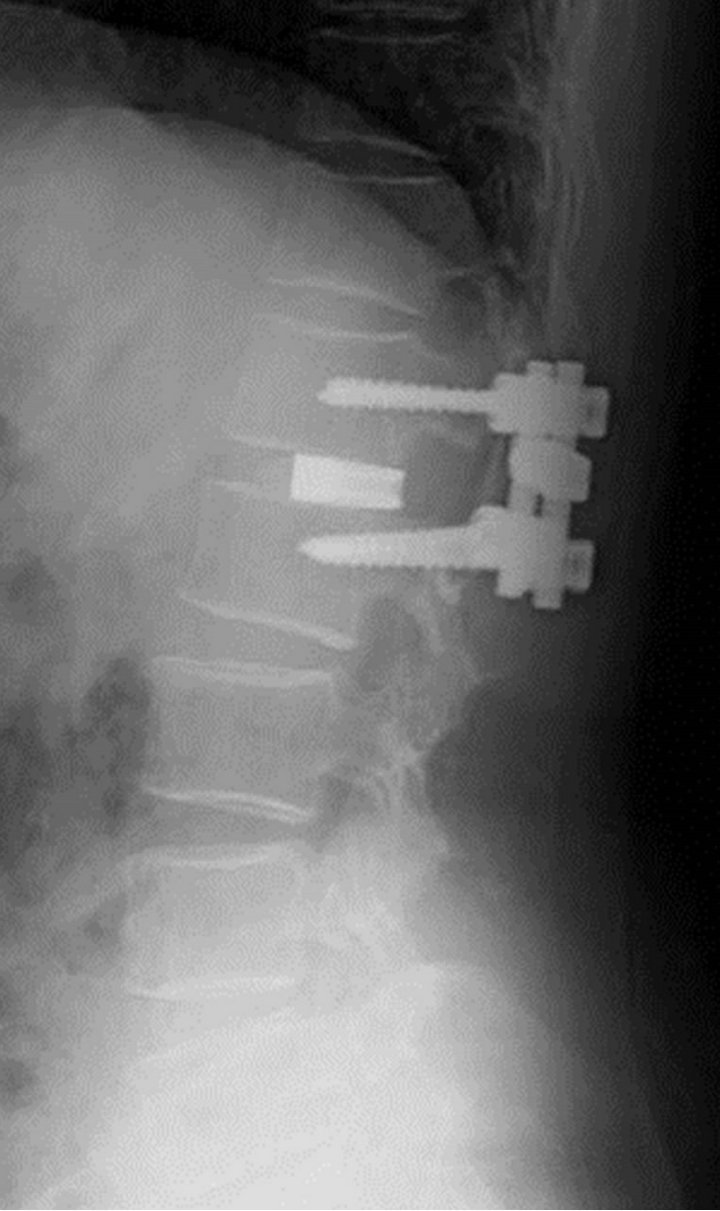 Lumbar Disc Herniation With End Plate Fracture And Secondary lumbar-disc-herniation-with-end-plate-fracture-and-secondary