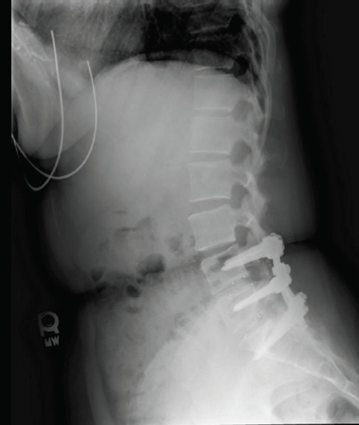 Epidural Blood Patch for Treatment of Postdural Puncture Headache in a
