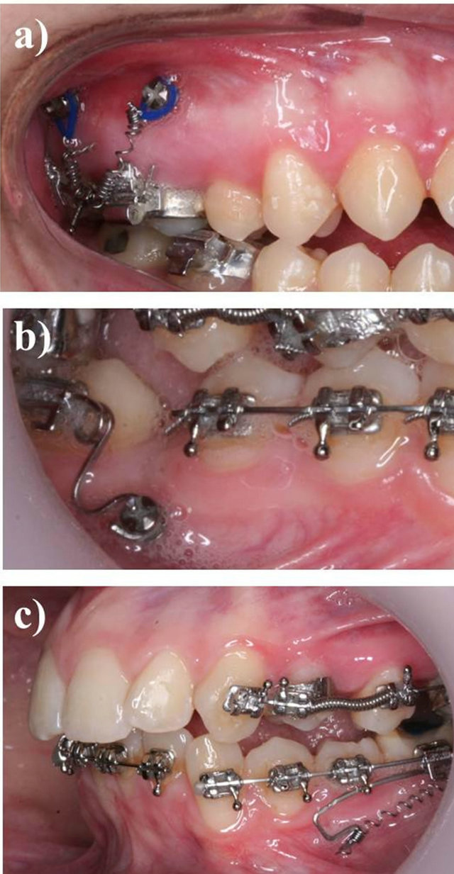 Miniscrew appliances and their use in orthodontics