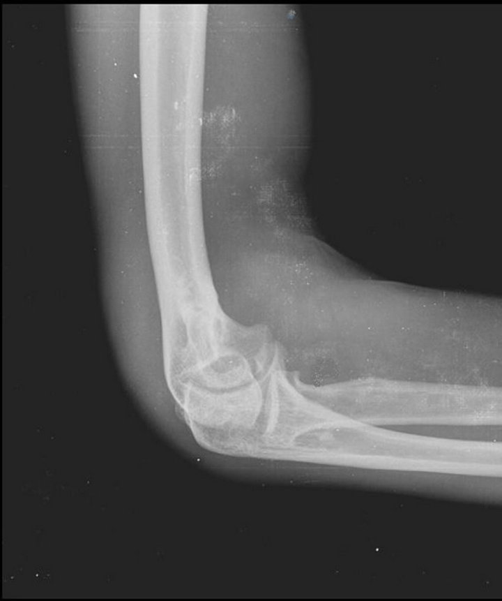 Synovial Chondromatosis of the Elbow Joint in a 27YearOld Man A Case