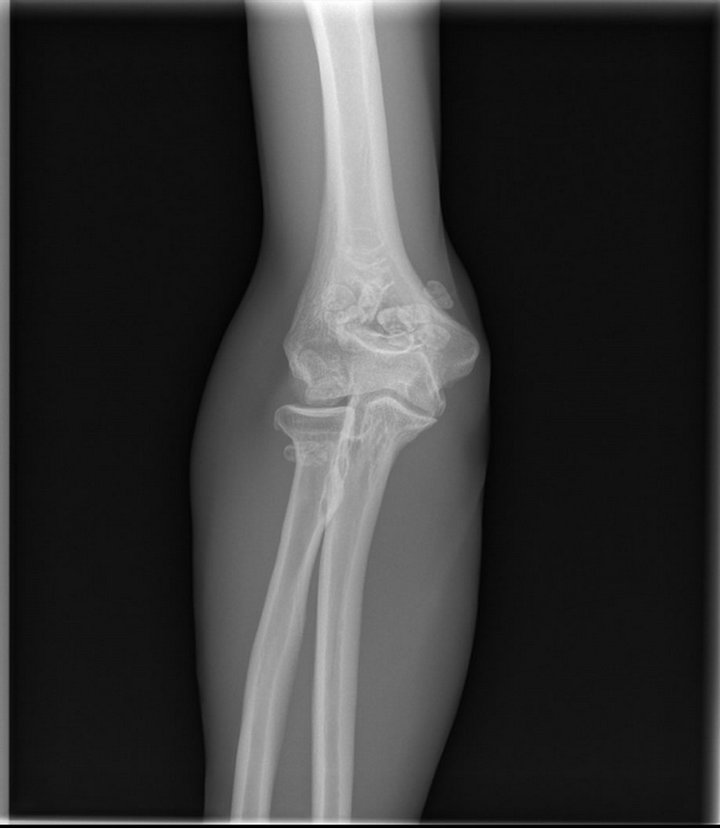 Synovial Chondromatosis of the Elbow Joint in a 27YearOld Man A Case