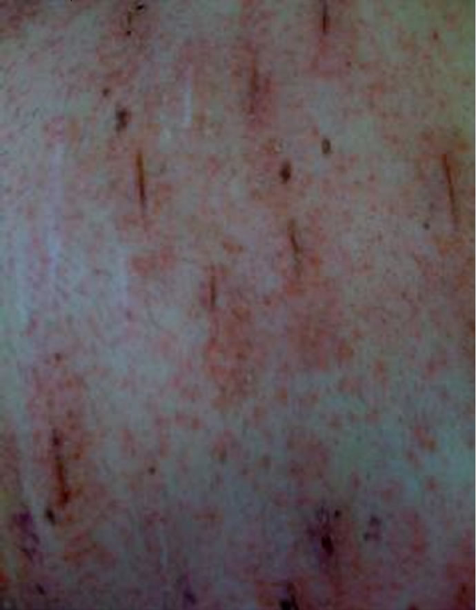 An example of allergic contact dermatitis to Dermabond Prineo (Ethicon