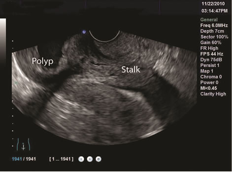Recurrent Prolapsed Giant Uterine Polyp Comprised of Adenomyotic Cysts