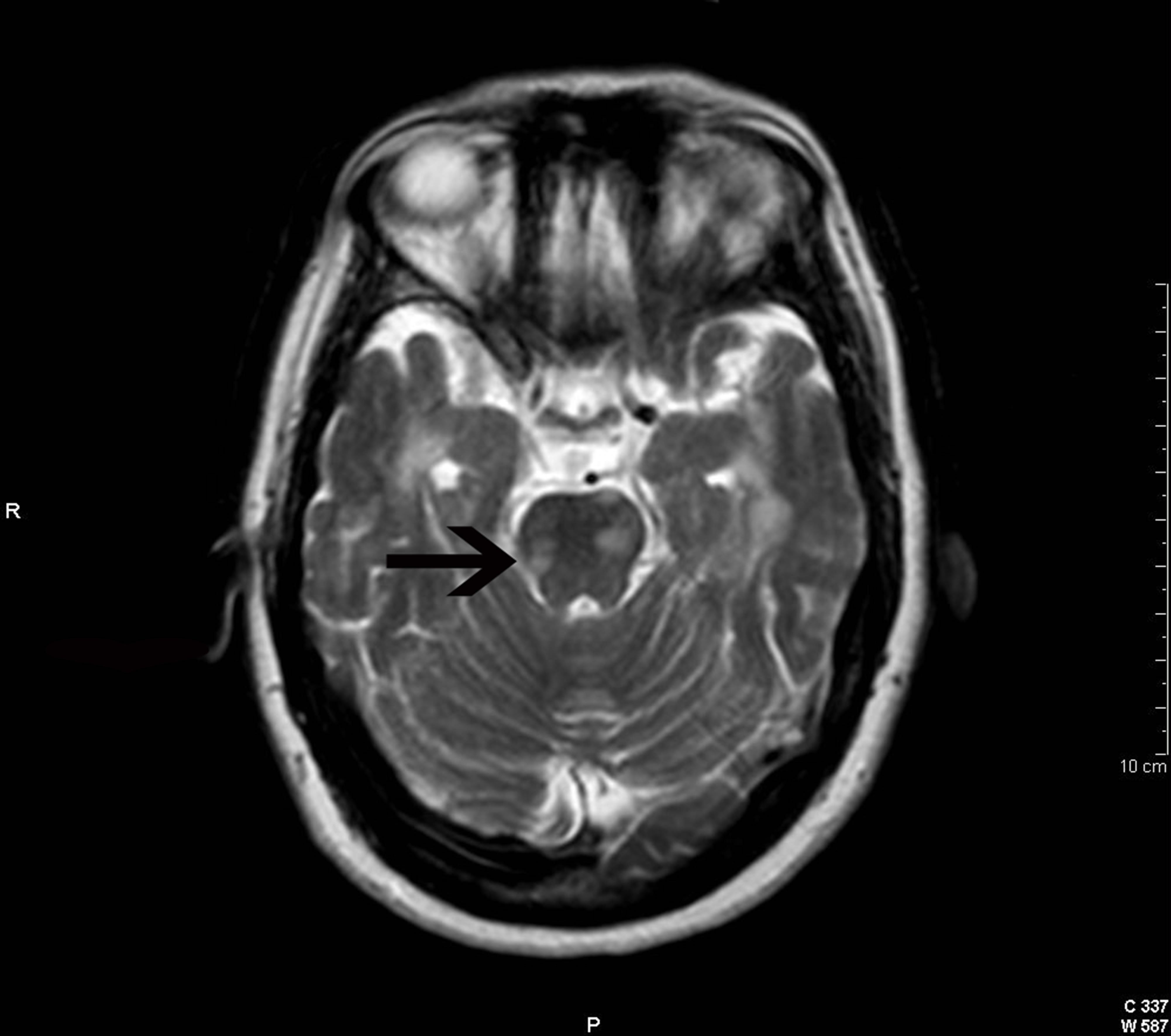 Clinico Radiological Dissociation In Multiple Sclerosis Future Prospects