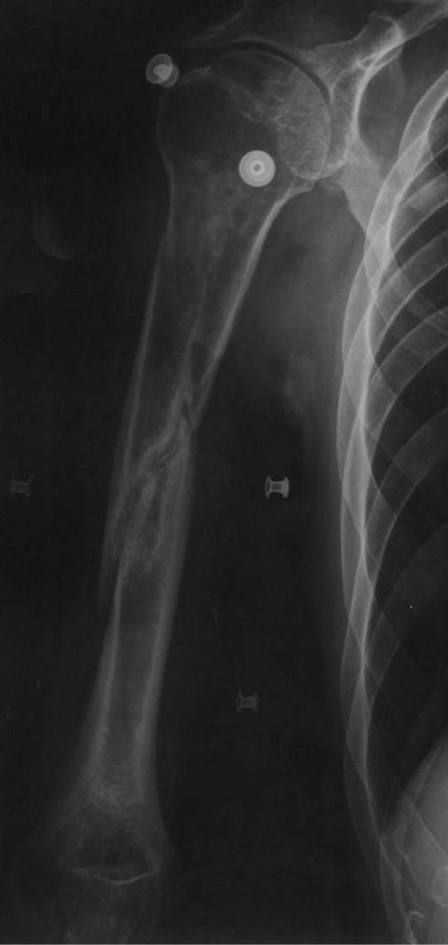 MANUAL OF INTERNAL FIXATION TECHNIQUE RECOMMENDED BY THE AO GROUP SWISS ASSOCIATION FOR THE STUDY OF INTERNAL FIXATION ASIF PDF visual data 6
