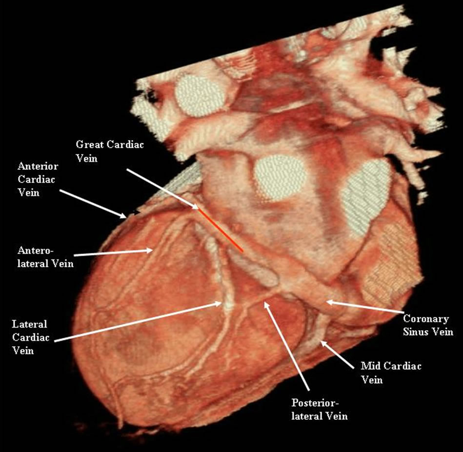 Evaluation Of Coronary Venous Anatomy By Multislice Computed Tomography