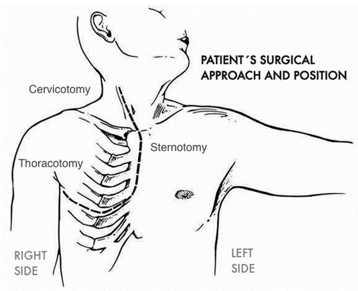 Thoracic Epidural Morphine for Postoperative Analgesia after