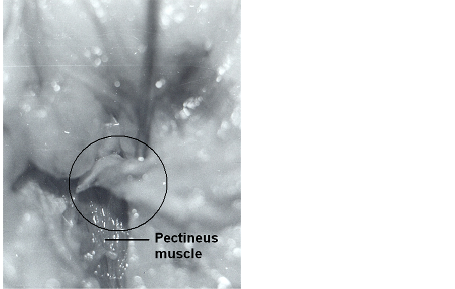 The Femoral Hernia Some Necessary Additions