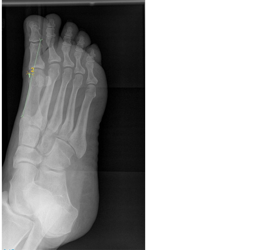 A Method for Measurement of the Hypertrophic First Metatarsal Medial
