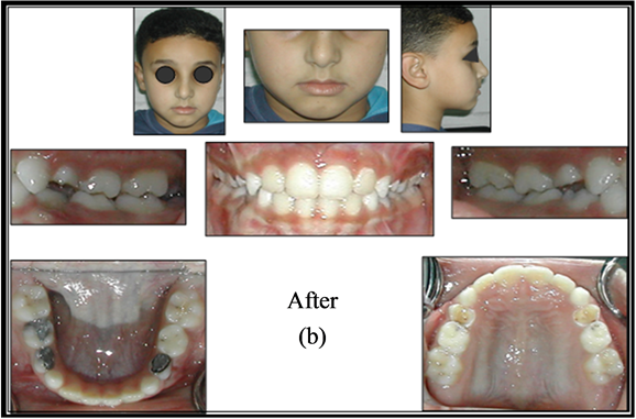 Orthopedic Correction of Class III Malocclusions during Mixed Dentition