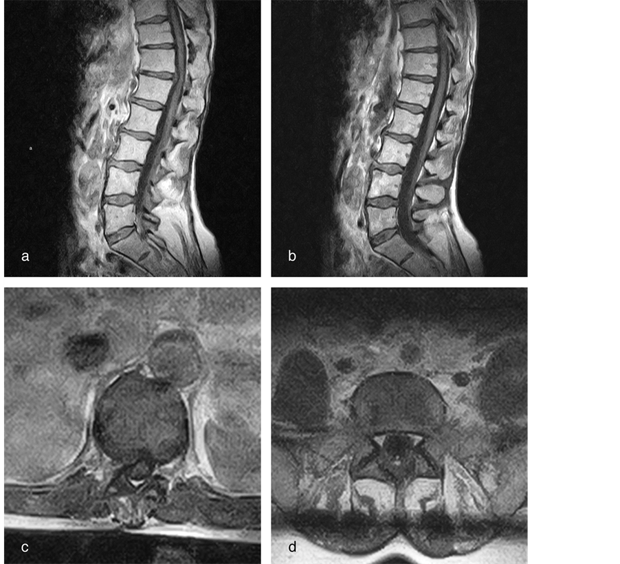 Thoraco Lumbar Junction Disc Herniation And Tight Filum A Unique Combination
