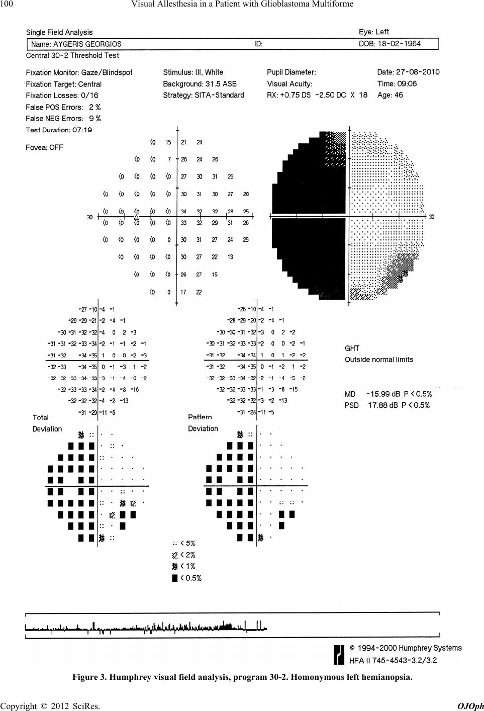 Visual Allesthesia in a Patient with Glioblastoma Multiforme