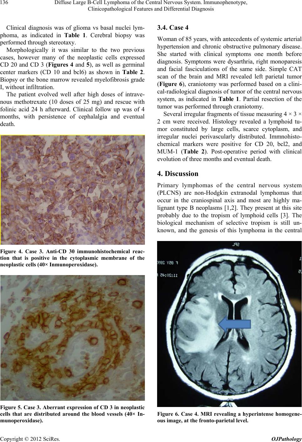 Diffuse Large BCell Lymphoma of the Central Nervous System