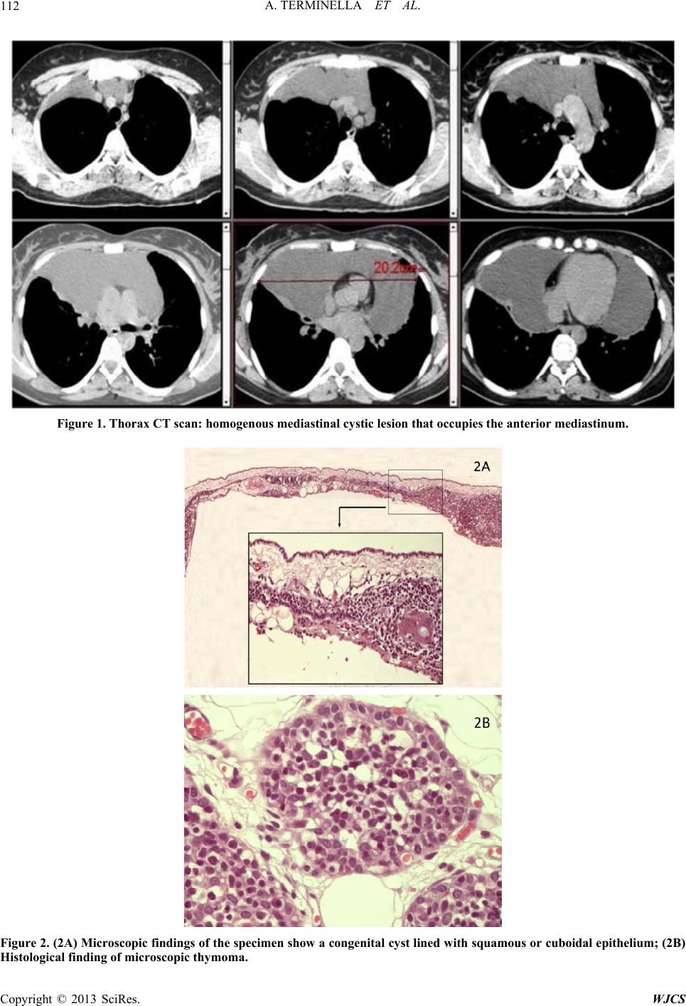 Huge Congenital Thymic Cyst with Microscopic Thymoma