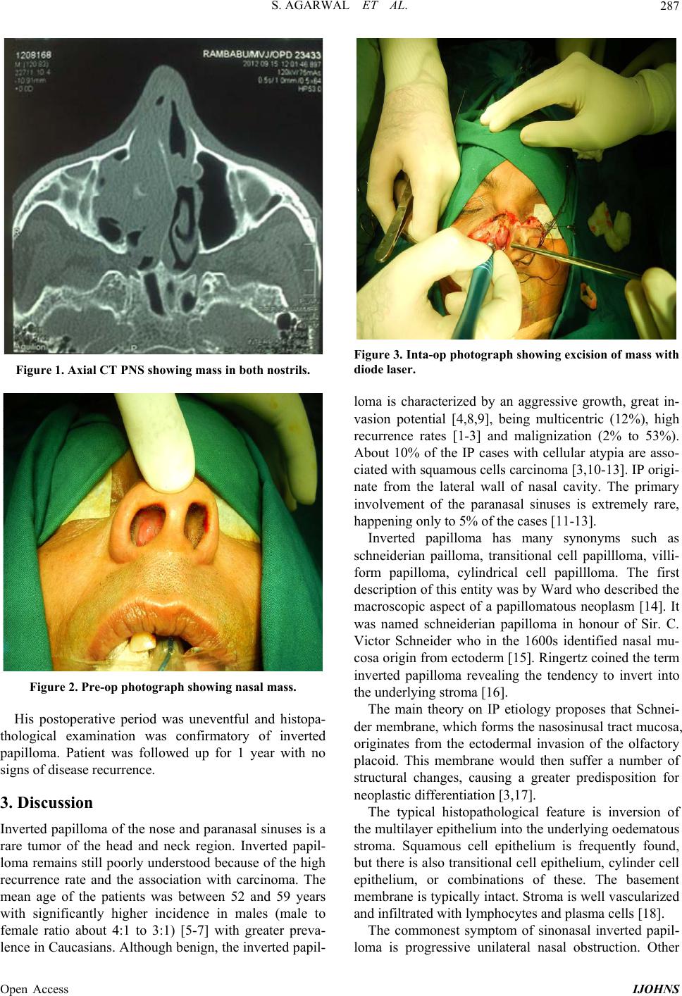 inverted nasal papilloma