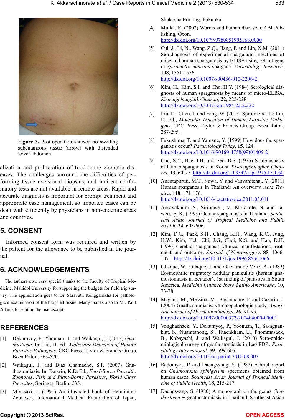Subcutaneous Larva Migrans Of A Sparganum In A Gnathostomiasis Endemic Area