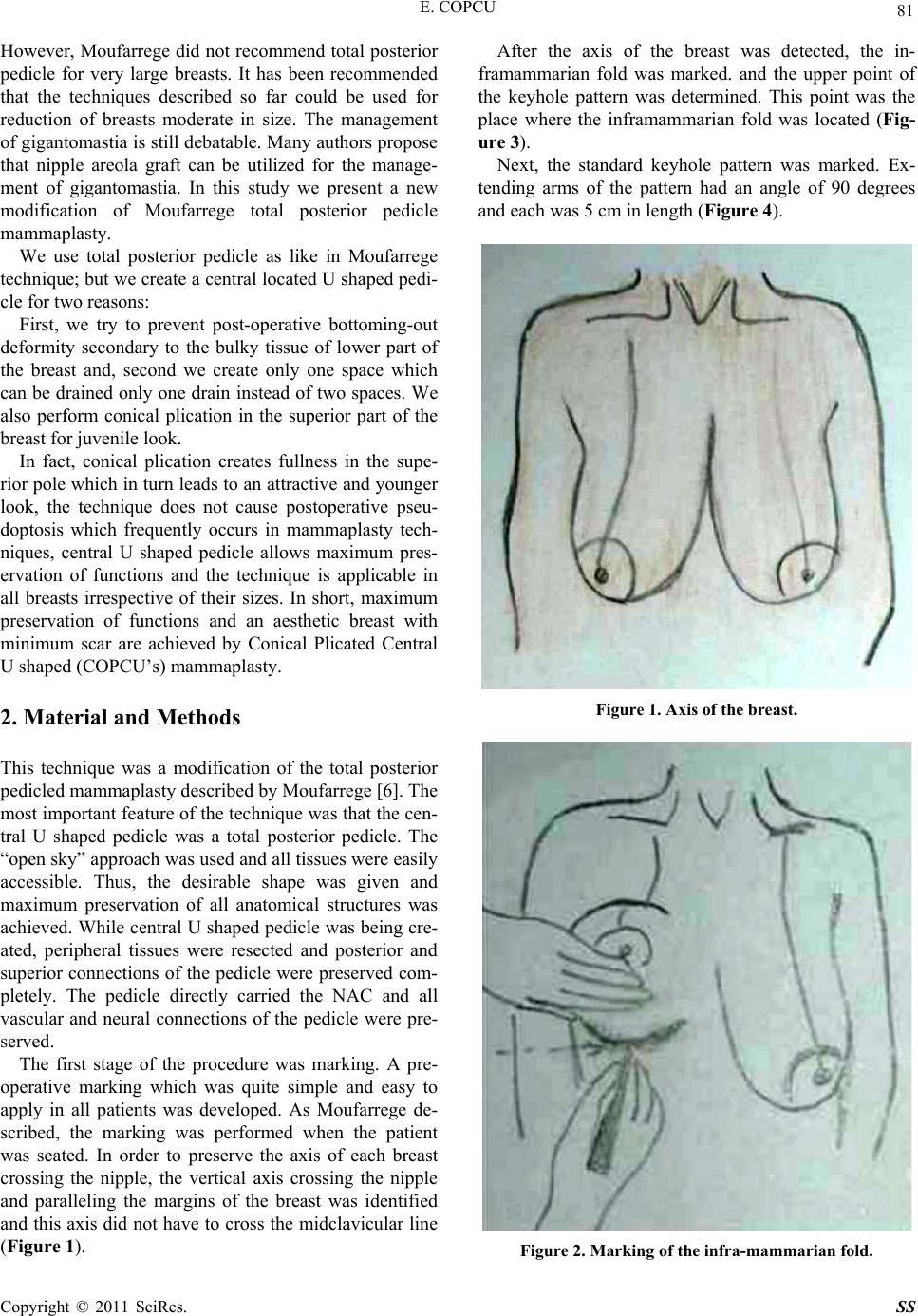 Modification of Moufarrege Total Posterior Pedicle Mammaplasty